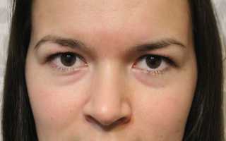 От каких заболеваний возникают отеки под глазами?