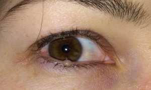 Методы лечения кисты на веке