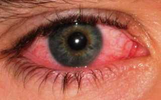 Есть ли противопоказания к занятиям спортом во время конъюнктивита