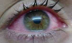 Самые часто встречающиеся глазные заболевания