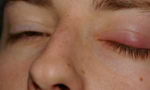 Причина отека в одном верхнем веке