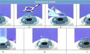 Показания к ласик операции и противопоказания