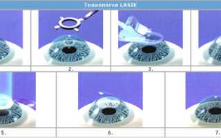 Показания к ласик операции и противопоказания