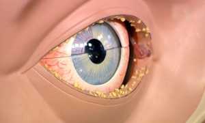 Заболевания которые вызывают загноение глаз