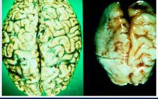 Все о влиянии алкогольных напитков на человека