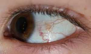 Возникновение кисты на глазу. Способы удаления