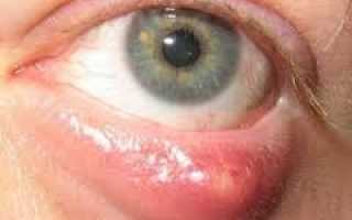 Причины возникновения гнойного ячменя