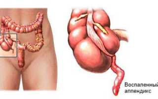 Как устранить тошноту в домашних условиях