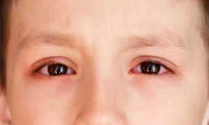 Вирусный конъюнктивит у ребенка: лечение и профилактика