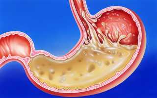 Что делать, если после приема таблеток болит желудок