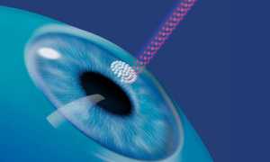 Показания к лазерной коррекции для исправления зрения