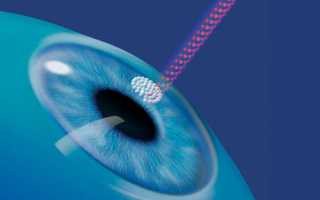 Показания к лазерной коррекции для исправления зрения