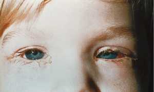 Бактериальный конъюнктивит у ребенка, виды лечений