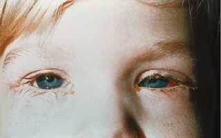 Бактериальный конъюнктивит у ребенка, виды лечений