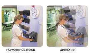 Причины и лечение двоения в глазах