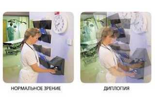 Причины и лечение двоения в глазах