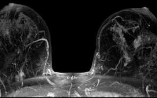 Инфильтративно отечная форма рака молочной железы