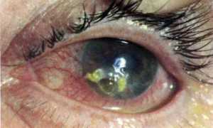 Что такое герпетический кератит и способы лечения