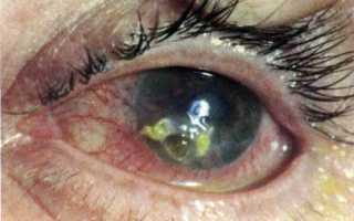 Что такое герпетический кератит и способы лечения