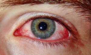 Причины лопнувших сосудов глаз