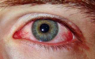 Причины лопнувших сосудов глаз