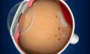 Стекловидное тело: лечение патологий