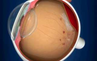 Стекловидное тело: лечение патологий