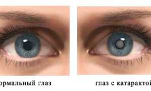Операция по удалению катаракты, послеоперационный период