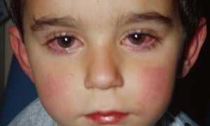 Особенности лечения глаз у детей. Основные заболевания и профилактика