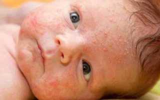 Стафилококковый дерматит — признаки, лечение