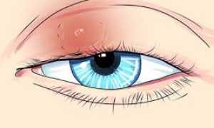 Советы для быстрого излечения от ячменя и способы профилактики