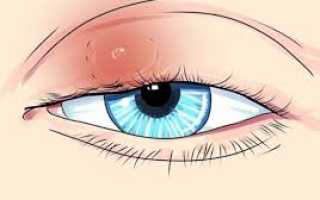 Советы для быстрого излечения от ячменя и способы профилактики