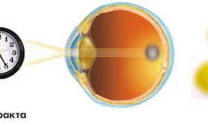 Виды и степени катаракт, профилактика избежания недуга