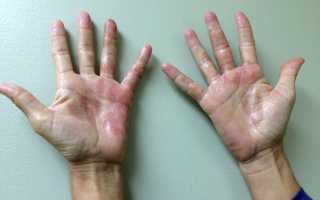 Заболевания кожи рук фото и названия