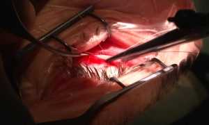 Исправление косоглазия с помощью операции