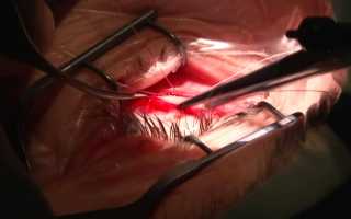 Исправление косоглазия с помощью операции