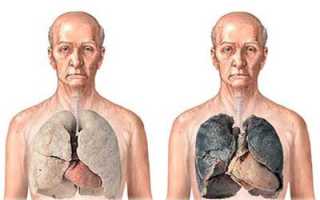 Как восстановить легкие от никотина после курения