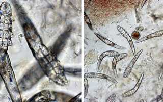 Клещ демодекс причины и лечение