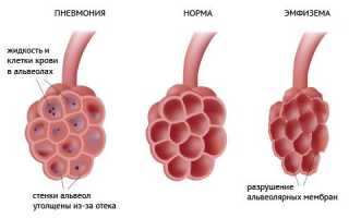 Симптомы и лечение передозировки «Амбробене»