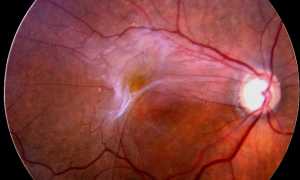 Народные рецепты для лечение фиброза сетчатки глаза