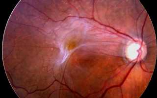 Народные рецепты для лечение фиброза сетчатки глаза