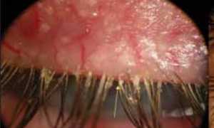 Какие анализы сдавать при подозрении на демодекоз