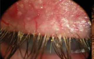 Какие анализы сдавать при подозрении на демодекоз