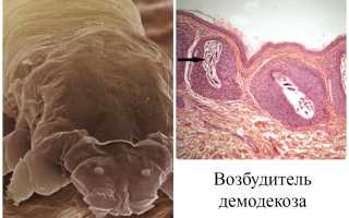 Фото, описание и лечение кожного клеща демодекс