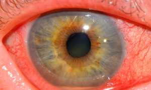Виды увеита и особенности терапии