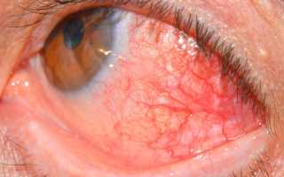 Симптомы дистрофии роговицы, виды терапии