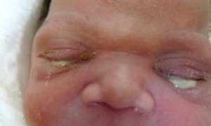 Дакриоцистит у новорожденных, лечение патологии