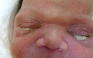 Дакриоцистит у новорожденных, лечение патологии