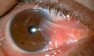 Что такое птеригиум глаза?