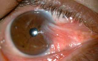 Что такое птеригиум глаза?